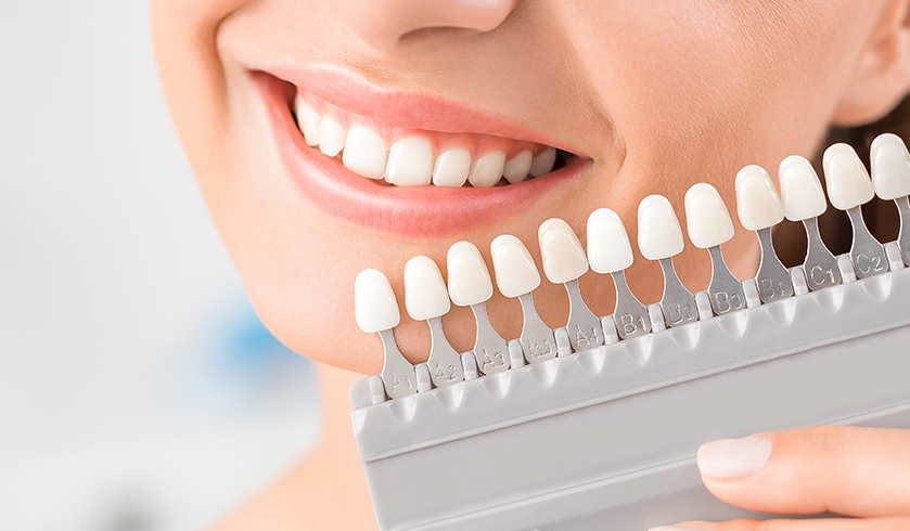 Top 10 Clinics for Veneers in London When Tooth Shades Differ